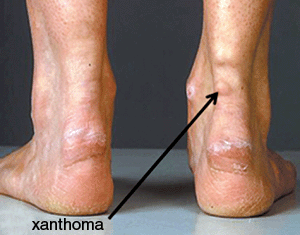 Xanthomas Of The Achilles Tendon Treatment Foot Doctor Southlake Xanthomas Of The Achilles Tendon Treatment Foot Doctor Southlake