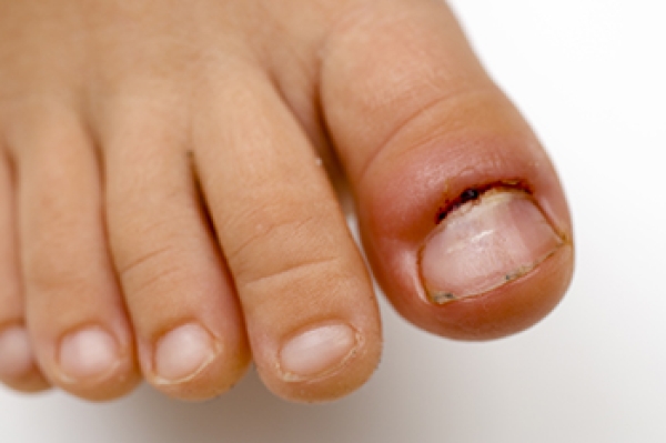 Can an ingrown toenail cause pain in other parts of the body? - Quora
