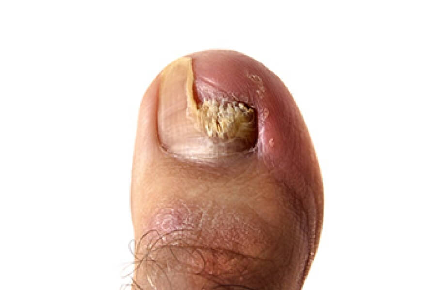 My Nails Have Fungus. Should I Still Get My Nails Done? - The Nail Bar  Beauty & Co.