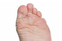 Caring for Calluses