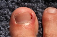 Ingrown Toenail Surgery Aftercare